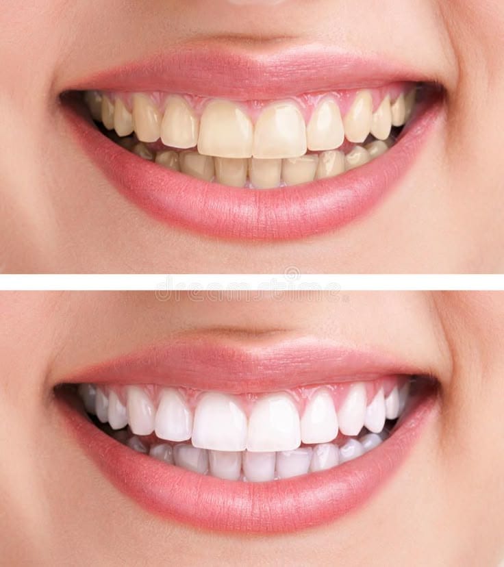 Whitening Solutions